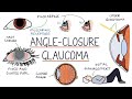 Understanding Acute Angle Closure Glaucoma