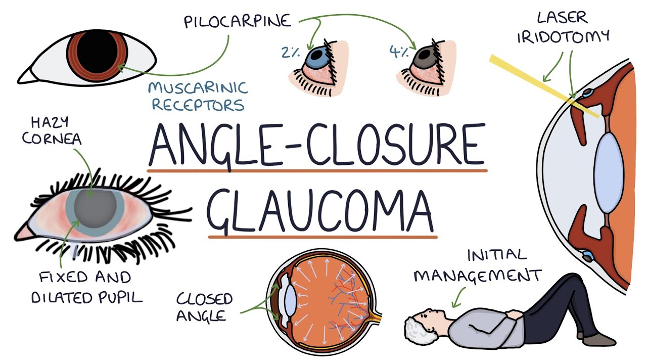 Understanding Acute Angle Closure Glaucoma