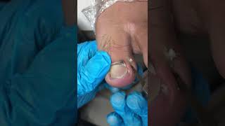 Amazing Toenail Trimming... #pedicure #toenails