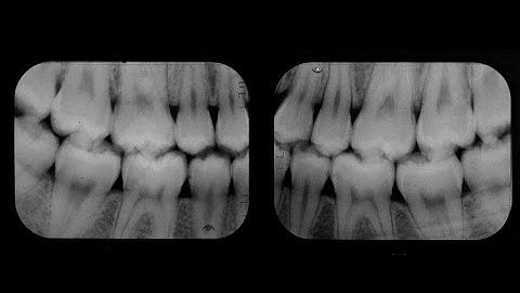 IRMER - Optimisation: Radiographic sensors and films. L6
