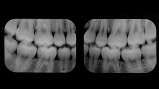 IRMER - Optimisation: Radiographic sensors and films. L6