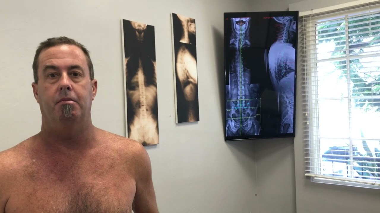 Мне прижгли нерв L5 из-за ишиаса! Не помогло. Уход Гонстеда после абляции нервного корешка.