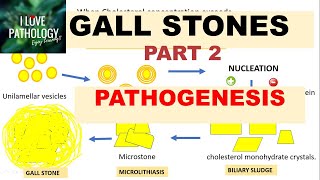 CHOLELITHIASIS/ GALL STONES-Part 2: Pathogenesis, Morphology, Clinical Features,Complications
