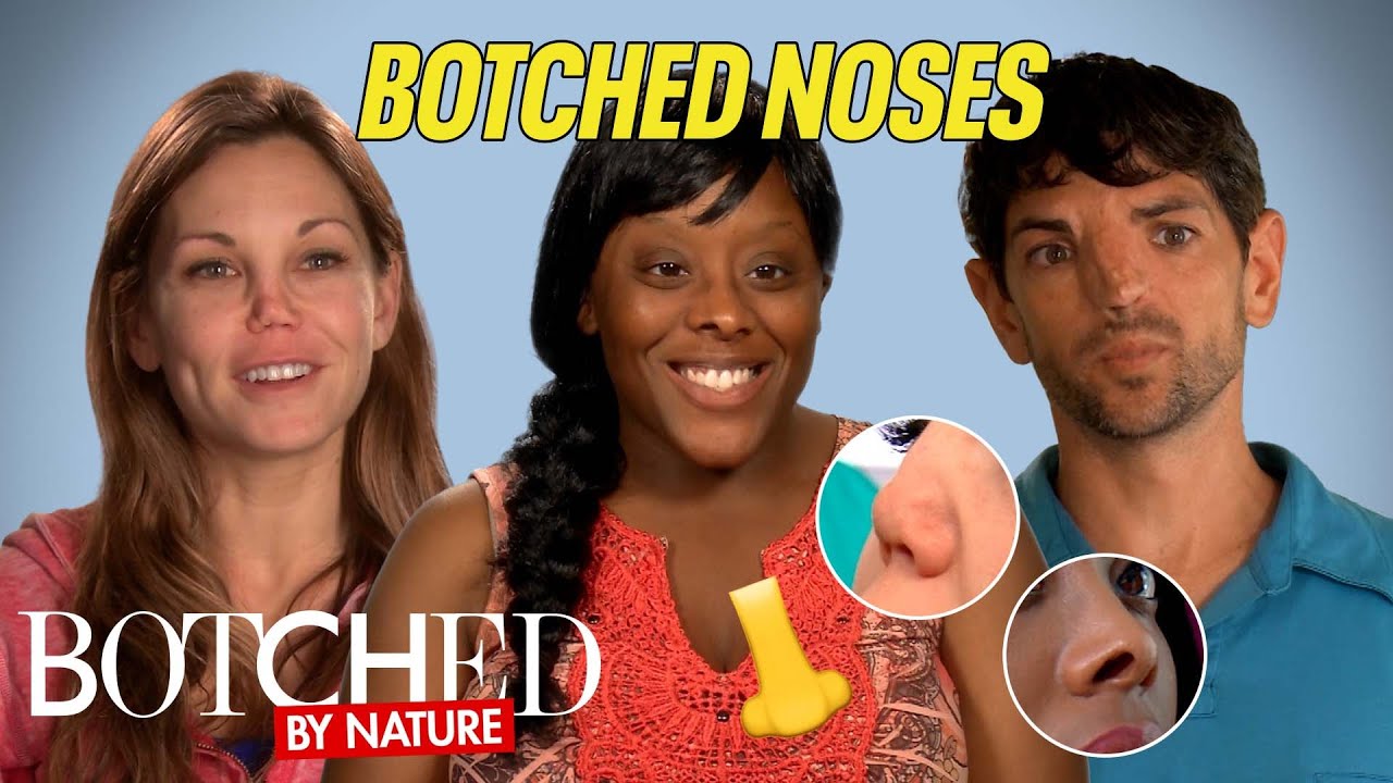 Испорченные носы: неразвитые кости, разрушенные хрящи и многое другое! (До и после) | Испорченные...