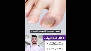 Medinail علاج فطريات الاظافر 0708800222