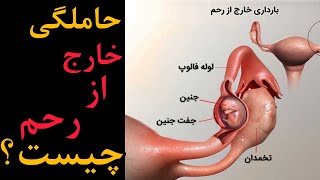 بارداری خارج از رحم چیست|حاملگی خارج از رحم|علائم حاملگی خارج از رحم