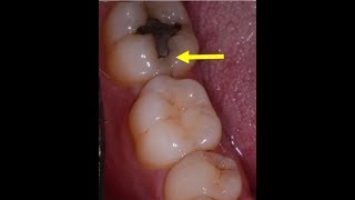 Kill tooth pain instantly under $10  1 Product no lie 100%