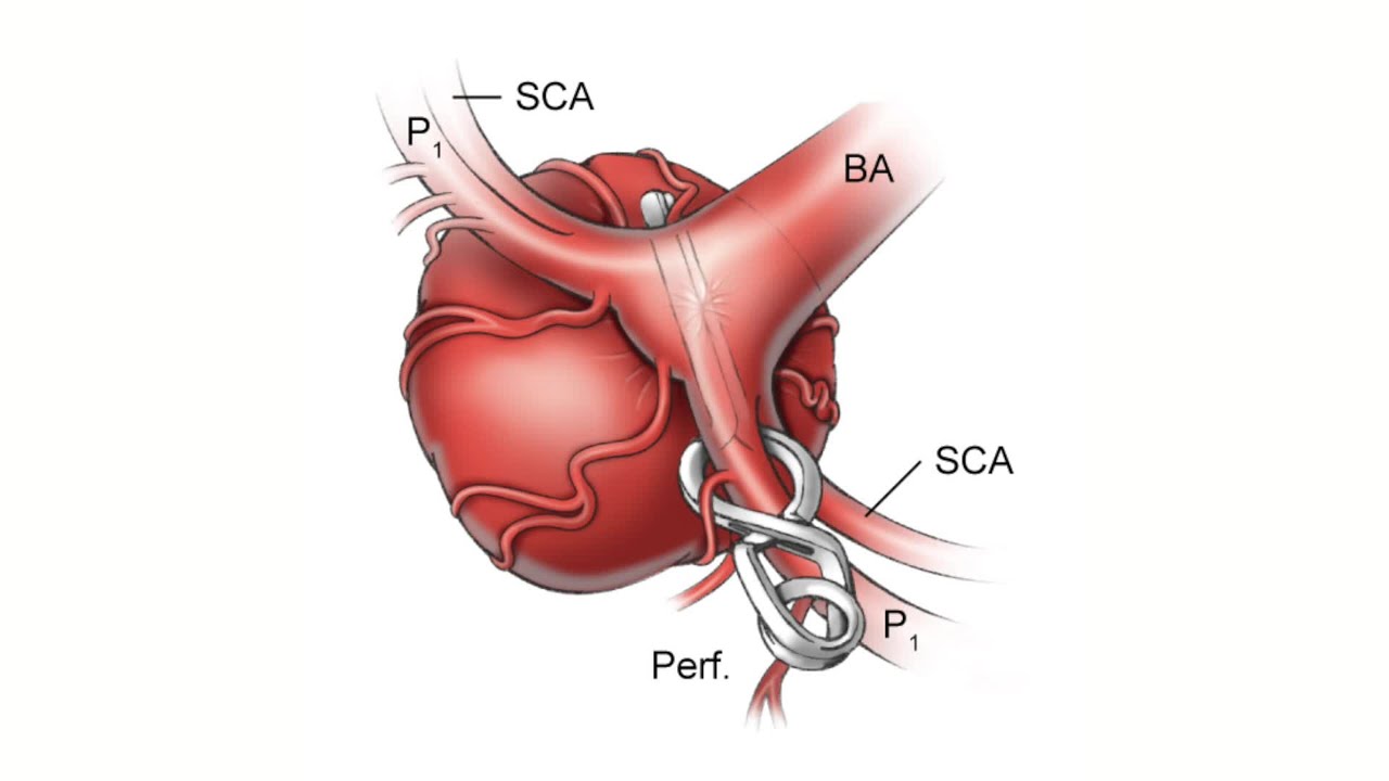 Episode 2: Beginning to Climb - Giant Basilar Tip Aneurysm Clipping