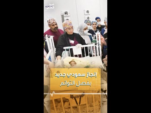 التوأم الإريتري الملتصق إنجاز طبي سعودي جديد في عمليات فصل التوائم