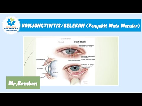 Konjungtivitis atau Belekan Penyakit Mata Menular   Program UKS SD Budi Mulia Dua Pandeansari