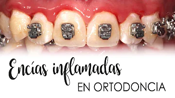 ¿Por qué se me inflama la encía entre 2 dientes?