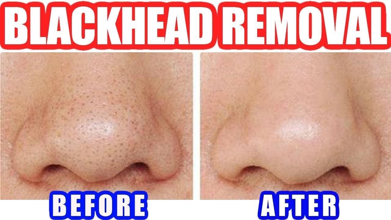Blackhead remover перевод. Blackhead Remover Moisturizing Pores полоски.