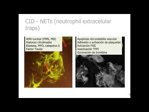 Vídeo: Diagnóstico Y Tratamiento De La Coagulación Intravascular Diseminada (DIC) De Acuerdo Con Cuatro Pautas De DIC