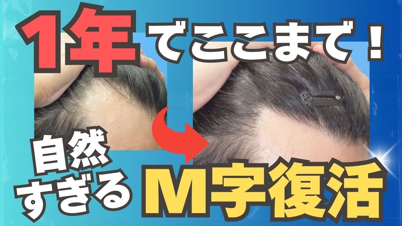 なぜこのM字は自然に見えるのか？30代男性、1430グラフトの1年後 - YouTube