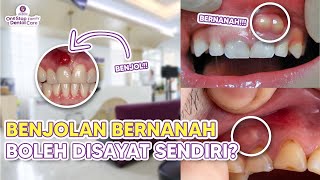 CAN YOU CUT A PUS-FILLED LUMP ON YOUR GUM? DENTAL ABSCESS