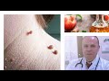 اسرع علاج منزلي طبيعي وفعال للتخلص من الزوائد الجلديه /SKIN TAGS REMOVAL