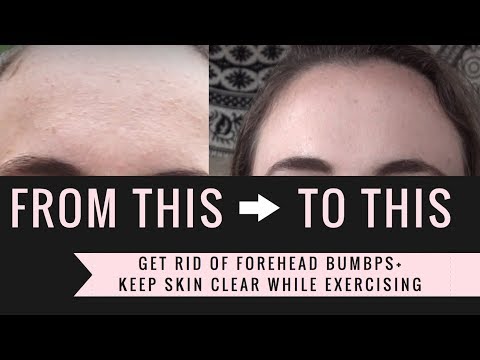 How To Get Rid of FOREHEAD BUMPS! + Keep skin clear while being active!