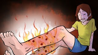Vasculitis | I Felt Like My Legs Were On Fire