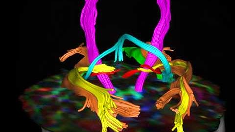 Fiber tractography