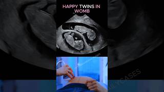 Twins Baby Boy Is Active Than Baby Girl Ultrasound Scan