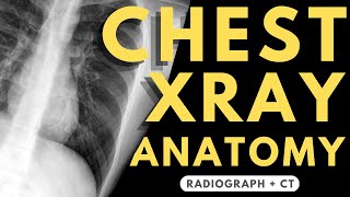 Chest X-ray Anatomy | Radiology anatomy part 1 prep | How to interpret a chest X-ray