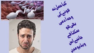 male infertility/causes of male infertility/treatment of male infertility/semen analysis