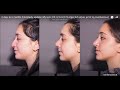 6 days to 6 months rhinoplasty update  my nose job recovery 6  6    