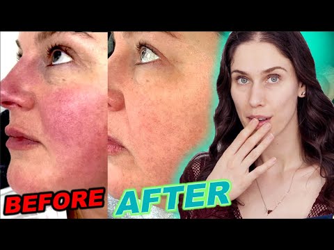Video: Kako tretirati kožu nakon kemijskog pilinga