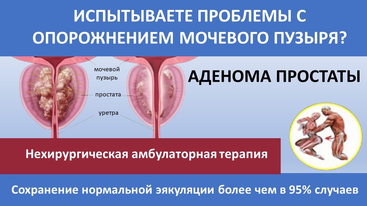 Лечение аденомы простаты | Гиперплазия простаты | Гиперплазия ...