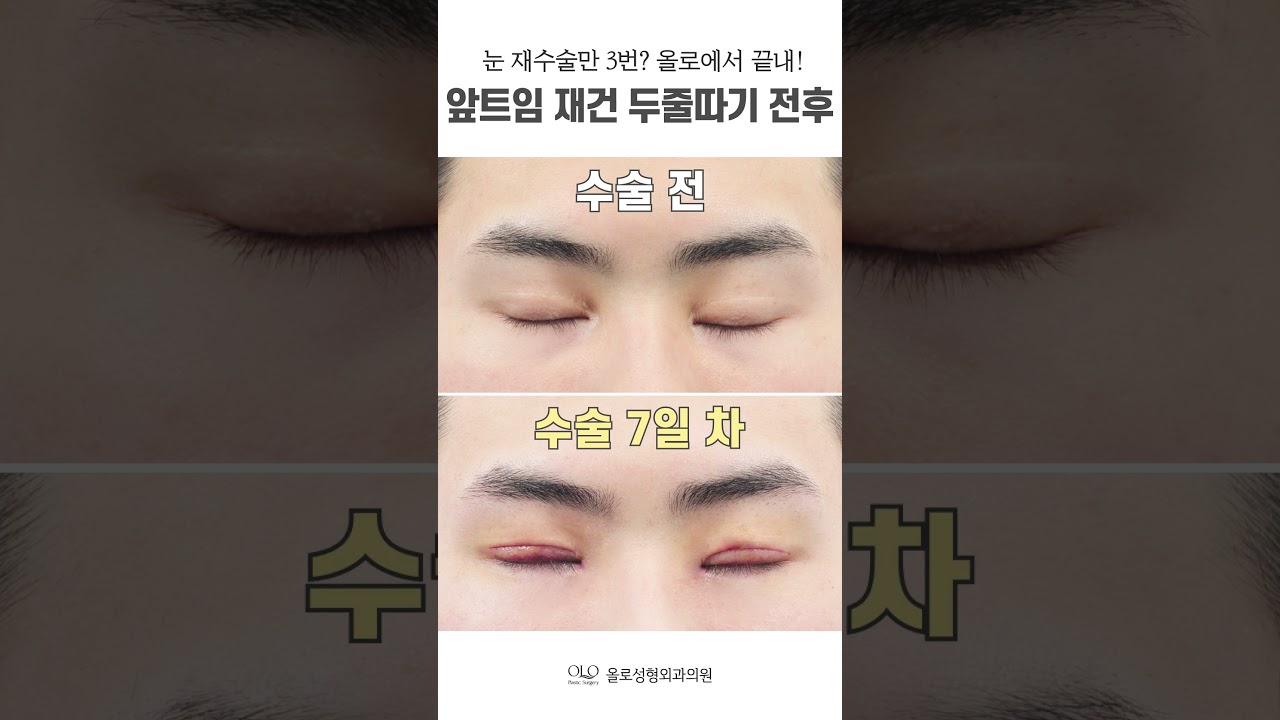 [奧露整形外科診所] #眼部再手術 4次就搞定！在奧露！ #困難眼型也沒問題！ #雙眼皮線條調整不難！ #開眼頭修復精準展現！ #shorts