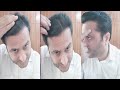 50 result 5 months 20 day result  best hair transplant result in pakistan 