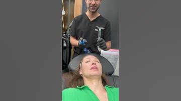 Microneedling with Exosomes