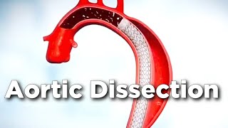 Aortic Dissection: The Silent Killer You Must Know About! #heart #cardio