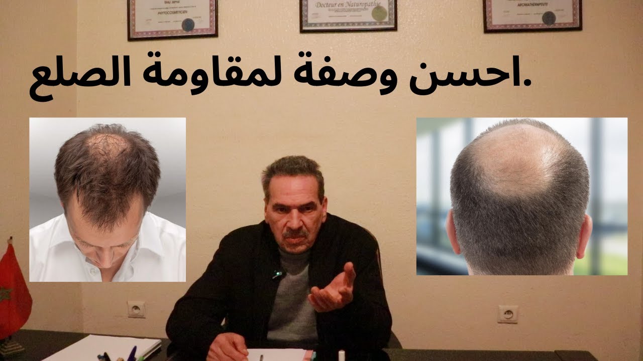 احسن وصفة لمقاومة الصلع.