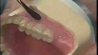 Waxing the Complete Denture