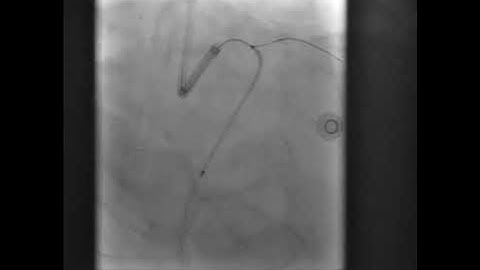 PCI to CTO LCX using microcatheter assisted antegrade wire escalation with LCX-OM TAP(case 3)