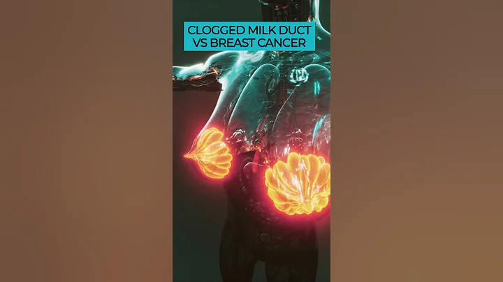 Clogged Milk Duct or Breast Cancer? Know the Signs and Act 🩺🎗️💕