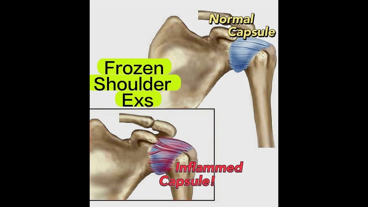 Frozen Shoulder Don't To Strengthen The Shoulder! YouTube