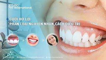 Cười hở lợi- phân loại- nguyên nhân và cách điều trị