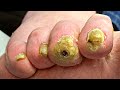 Trimming DEEP CALLUSES On Tip Of Toes!