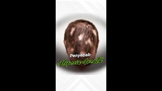 Rambut Rontok Karena Alopecia Areata Autoimun