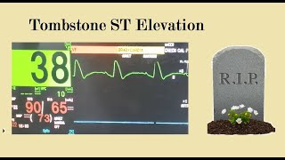 STEMI | Tombstone ST elevation