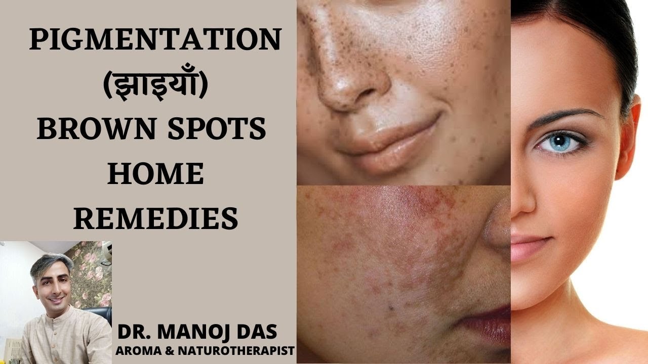 HOW TO REMOVE PIGMENTATION / FRECKLES / BROWN SPOTS / MELASMA I DR. MANOJ DAS
