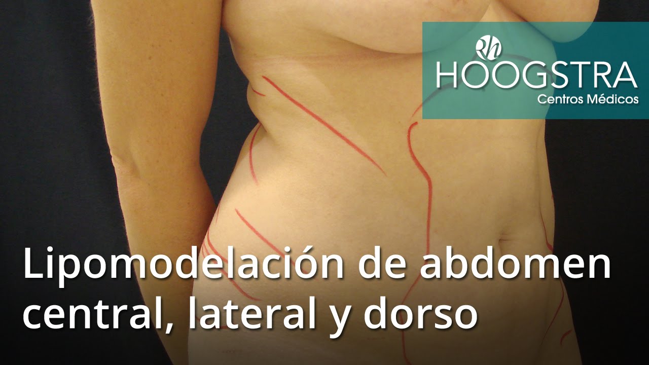 lipoma 意味 Lipomodelación de abdomen central, lateral y dorso (16094)