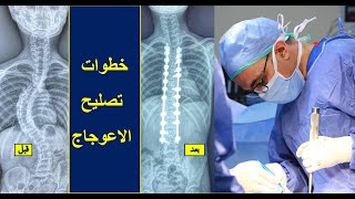 خطوات جراحة تصليح اعوجاج العمود الفقري (الجنف) يوضحها دكتور هاني عبدالجواد من داخل العمليات