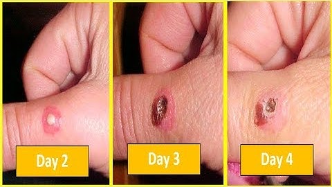Brown Recluse Spider Bite Pictures/Images Day 2, Day 3, Day 4 - Day by Day