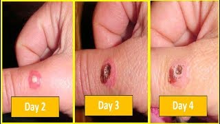 Brown Recluse Spider Bite Pictures/Images Day 2, Day 3, Day 4 - Day by Day