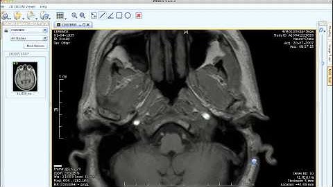 Weasis demo in osirix