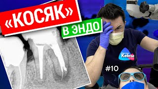 «Косяк» в эндо. Дентал Кейсы от BG #10