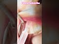 Maxillary second premolar extraction 💉🦷#viralvideo